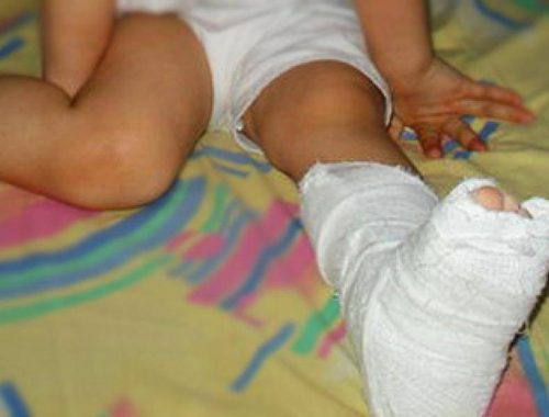 Ребенок получил перелом берцовой кости из-за падения на обледеневшем тротуаре в Биробиджане